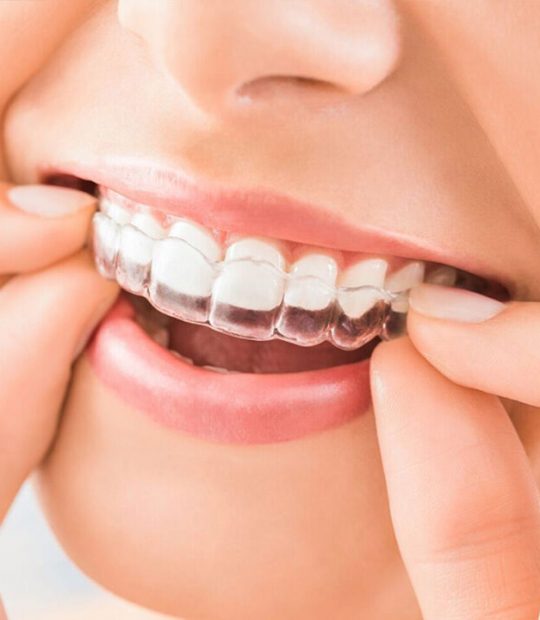 Invisalign-per-sito